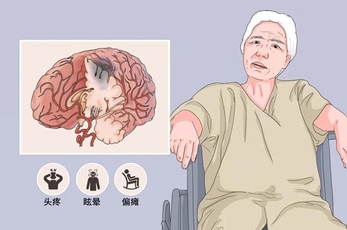 高血压会引起中风什么原因 如何治疗高血压引起的中风