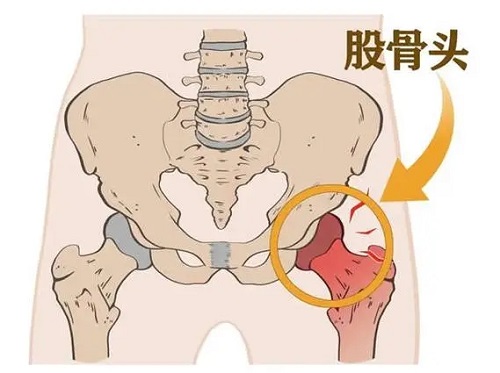 股骨头坏死能治吗 股骨头坏死能喝酒吗