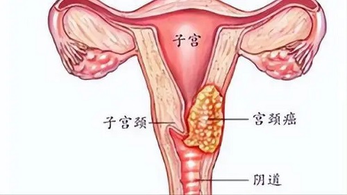 宫颈癌最准确的征兆是什么 宫颈癌可以治愈吗